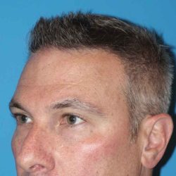 Juvéderm - Tear Troughs Before & After Patient #651