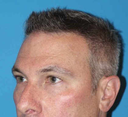 Juv&eacute;derm - Tear Troughs Before & After Patient #651