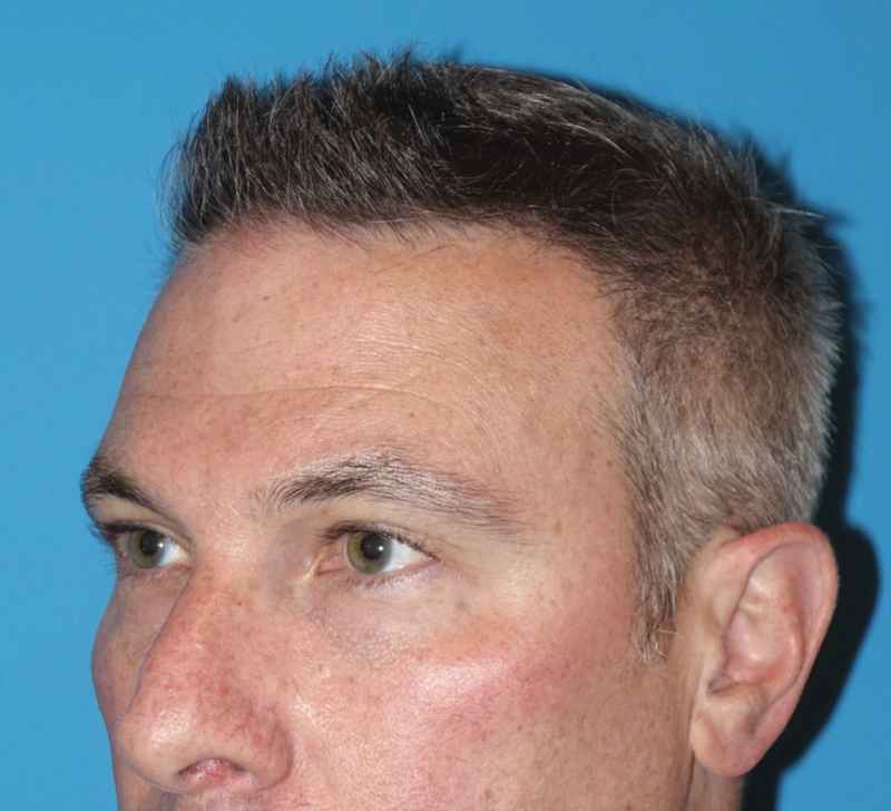 Juv&eacute;derm - Tear Troughs Before & After Patient #651