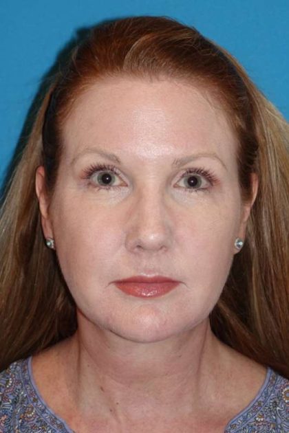 FaceTite Before & After Patient #704