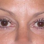 Fat Transfer Before & After Patient #715