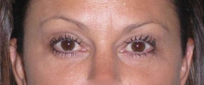 Fat Transfer Before & After Patient #715