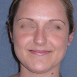 Otoplasty Before & After Patient #720