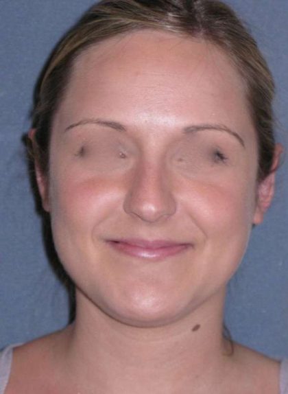 Otoplasty Before & After Patient #720