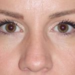 Eyelid Lift- Lower Before & After Patient #731