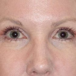 Eyelid Lift- Lower Before & After Patient #742