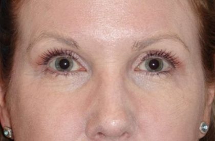 Eyelid Lift- Lower Before & After Patient #742