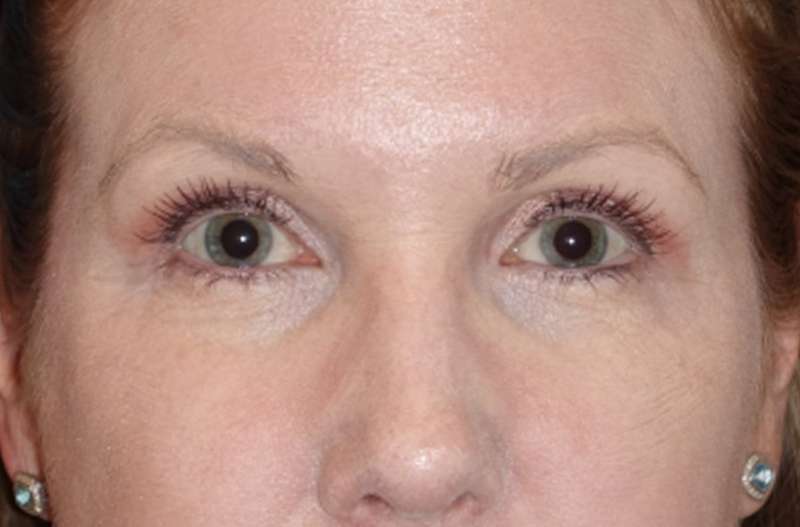 Eyelid Lift- Lower Before & After Patient #742