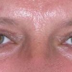 Eyelid Lift- Upper Before & After Patient #747
