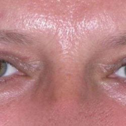 Eyelid Lift- Upper Before & After Patient #747