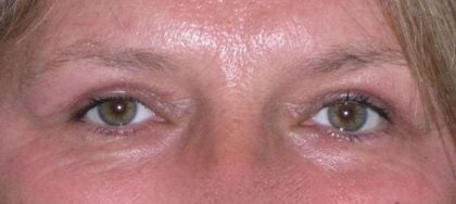 Eyelid Lift- Upper Before & After Patient #747