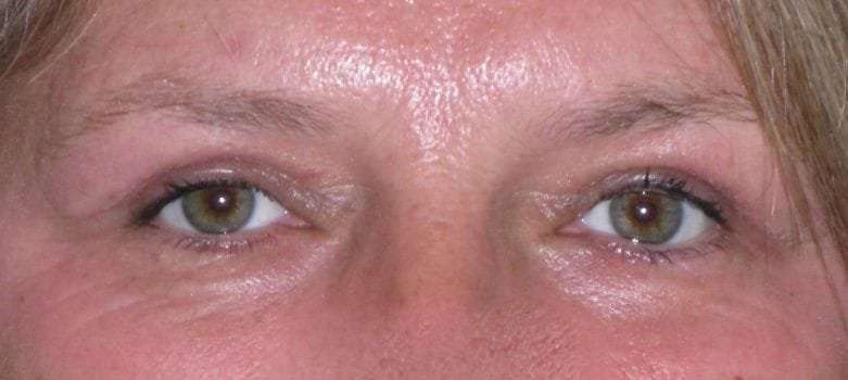 Eyelid Lift- Upper Before & After Patient #747