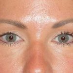 Juv&eacute;derm - Tear Troughs Before & After Patient #648