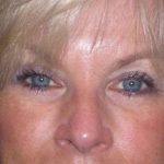 Eyelid Lift- Upper Before & After Patient #754