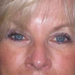 Eyelid Lift- Upper Before & After Patient #754