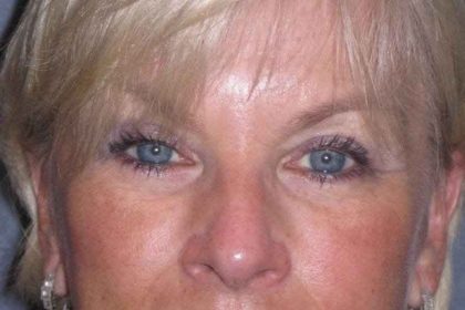 Eyelid Lift- Upper Before & After Patient #754