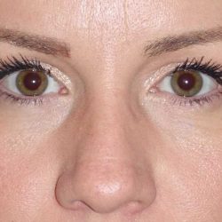 Eyelid Lift- Upper Before & After Patient #765