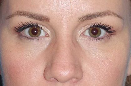 Eyelid Lift- Upper Before & After Patient #765