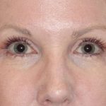 Eyelid Lift- Upper Before & After Patient #776