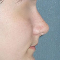 Rhinoplasty Before & After Patient #787