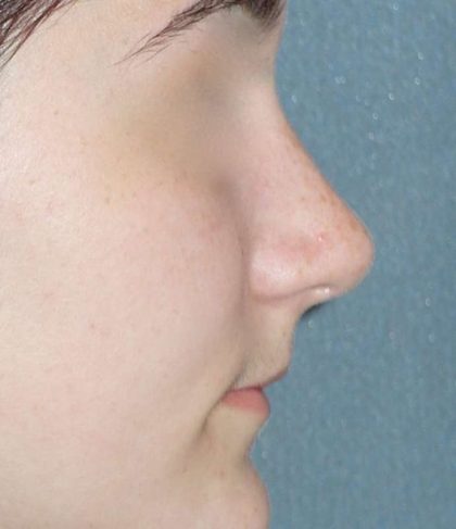 Rhinoplasty Before & After Patient #787