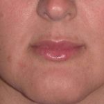 Juv&eacute;derm - Lips Before & After Patient #654