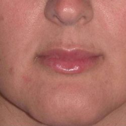 Juvéderm - Lips Before & After Patient #654
