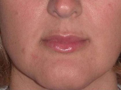 Juvéderm - Lips Before & After Patient #654