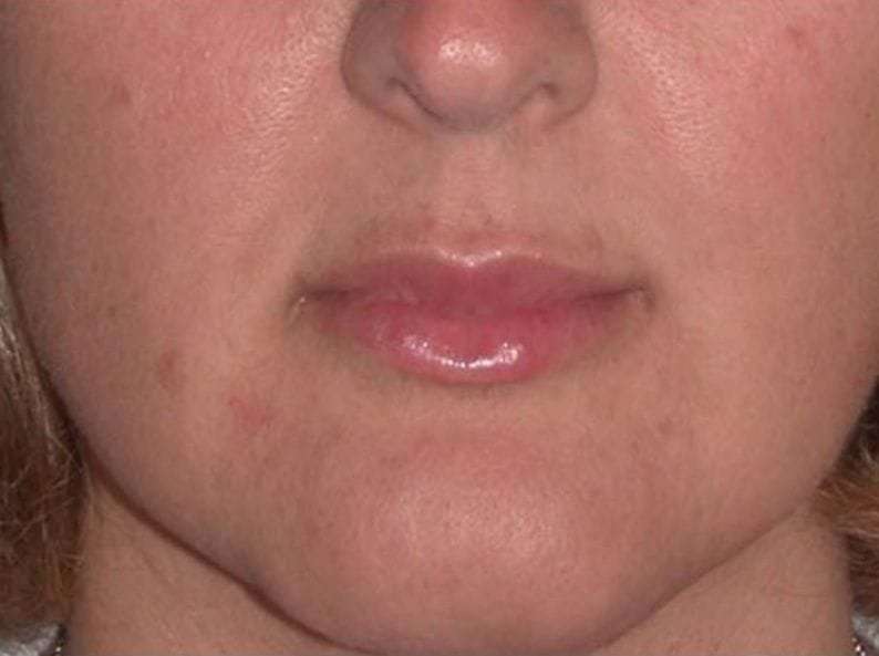 Juv&eacute;derm - Lips Before & After Patient #654