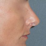 Rhinoplasty Before & After Patient #798