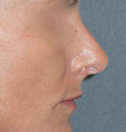 Rhinoplasty Before & After Patient #798