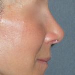 Rhinoplasty Before & After Patient #809