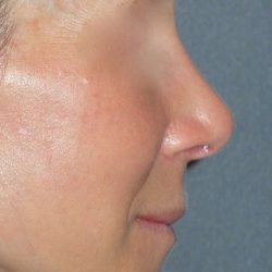 Rhinoplasty Before & After Patient #809
