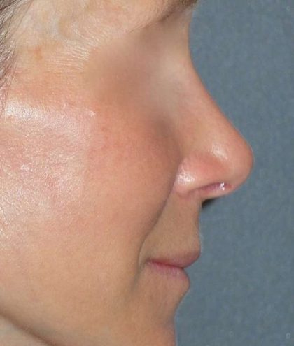 Rhinoplasty Before & After Patient #809