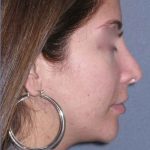 Rhinoplasty Before & After Patient #816