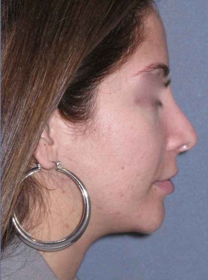 Rhinoplasty Before & After Patient #816