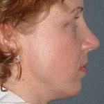 Rhinoplasty Before & After Patient #823
