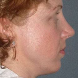 Rhinoplasty Before & After Patient #823