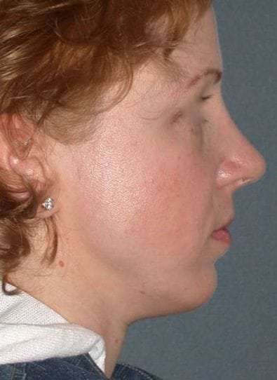 Rhinoplasty Before & After Patient #823