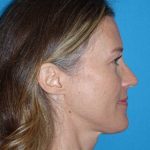 Rhinoplasty Before & After Patient #834