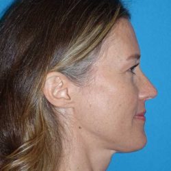 Rhinoplasty Before & After Patient #834