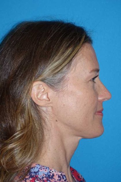 Rhinoplasty Before & After Patient #834