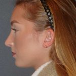 Rhinoplasty Before & After Patient #845