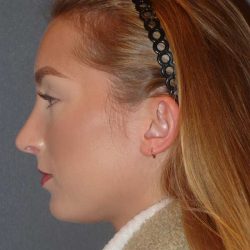 Rhinoplasty Before & After Patient #845