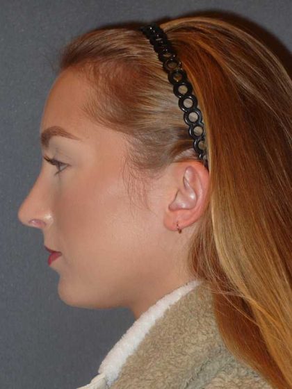 Rhinoplasty Before & After Patient #845