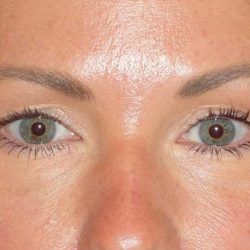 Juvéderm - Tear Troughs Before & After Patient #648