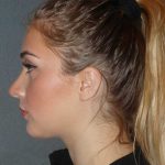 Rhinoplasty Before & After Patient #856