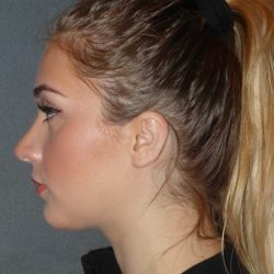 Rhinoplasty Before & After Patient #856
