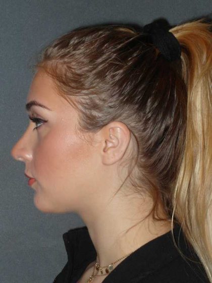 Rhinoplasty Before & After Patient #856