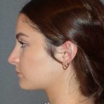 Rhinoplasty Before & After Patient #867